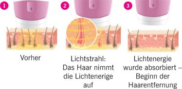 Sanitas Ipl 100 Produktvorstellung Erfahrungen Bewertung