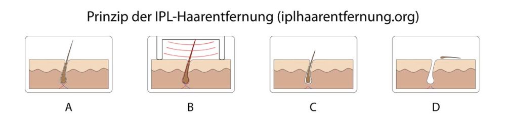 IPL Haarentfernung - FAQ für dauerhaft glatte Haut